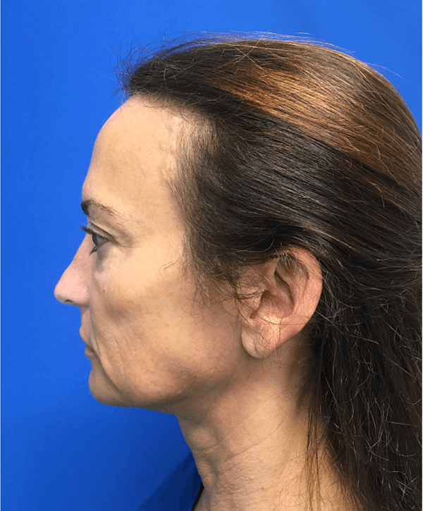 Hair Restoration Before & After Gallery - Patient 341765 - Image 5