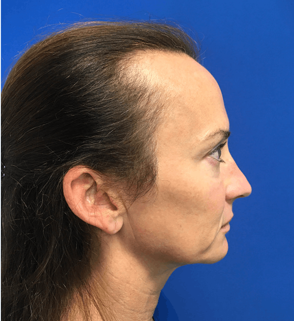 Hair Restoration Before & After Gallery - Patient 341765 - Image 3