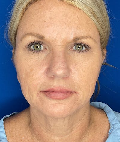 Neck Lift Before & After Gallery - Patient 247107 - Image 1