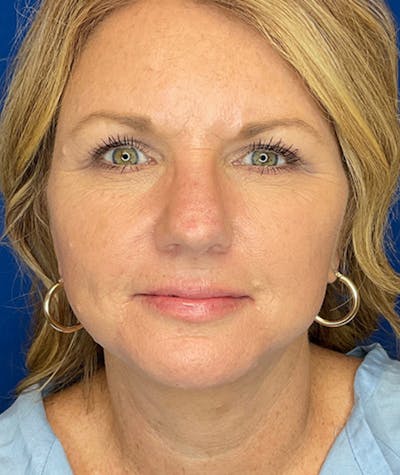 Neck Lift Before & After Gallery - Patient 247107 - Image 2