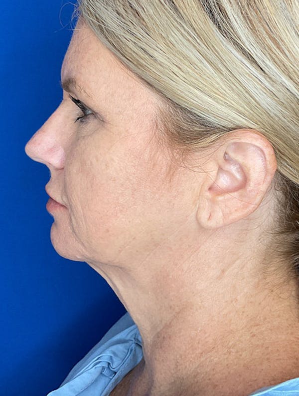 Neck Lift Before & After Gallery - Patient 247107 - Image 3