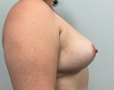 Breast Reduction Before & After Gallery - Patient 369091 - Image 6