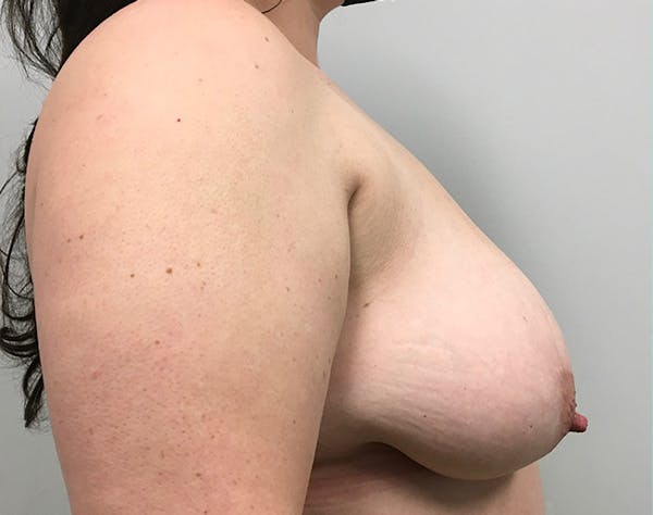 Breast Reduction Before & After Gallery - Patient 369091 - Image 5