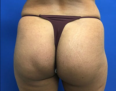 Brazilian Butt Lift Before & After Gallery - Patient 405651 - Image 1