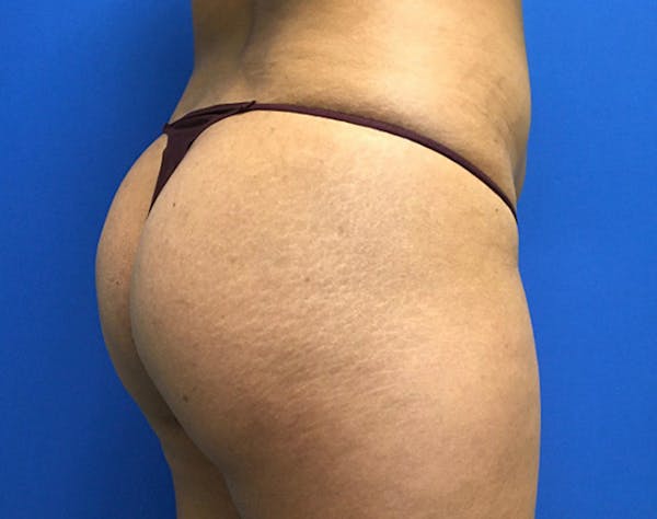 Brazilian Butt Lift Before & After Gallery - Patient 405651 - Image 3