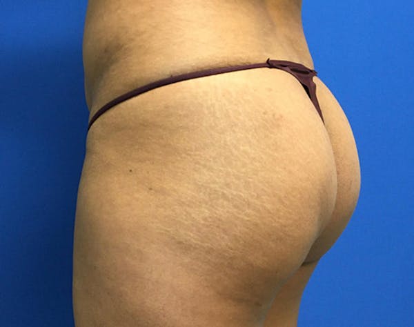 Brazilian Butt Lift Before & After Gallery - Patient 405651 - Image 5