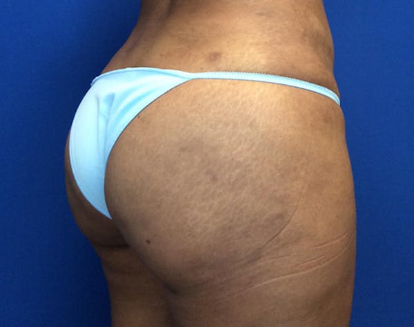 Brazilian Butt Lift Before & After Gallery - Patient 405651 - Image 4