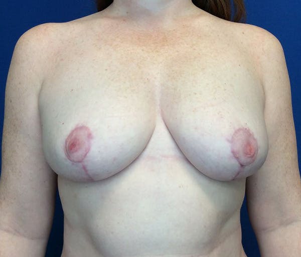 Breast Reduction Before & After Gallery - Patient 250173 - Image 2