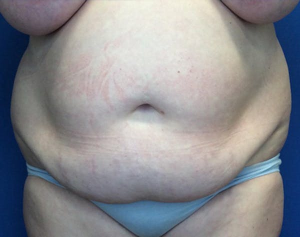 Tummy Tuck (Abdominoplasty) Before & After Gallery - Patient 148110 - Image 1