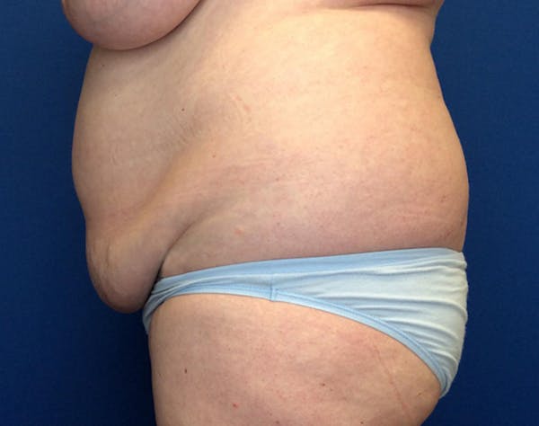 Tummy Tuck (Abdominoplasty) Before & After Gallery - Patient 148110 - Image 3