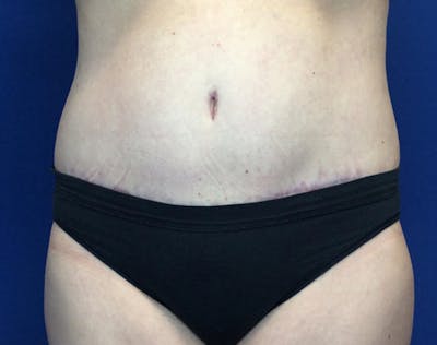 Tummy Tuck (Abdominoplasty) Before & After Gallery - Patient 148110 - Image 2