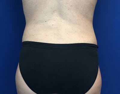 Tummy Tuck (Abdominoplasty) Before & After Gallery - Patient 148110 - Image 6