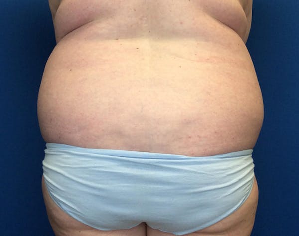 Tummy Tuck (Abdominoplasty) Before & After Gallery - Patient 148110 - Image 5