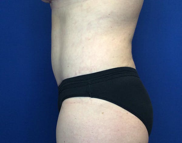 Tummy Tuck (Abdominoplasty) Before & After Gallery - Patient 148110 - Image 4