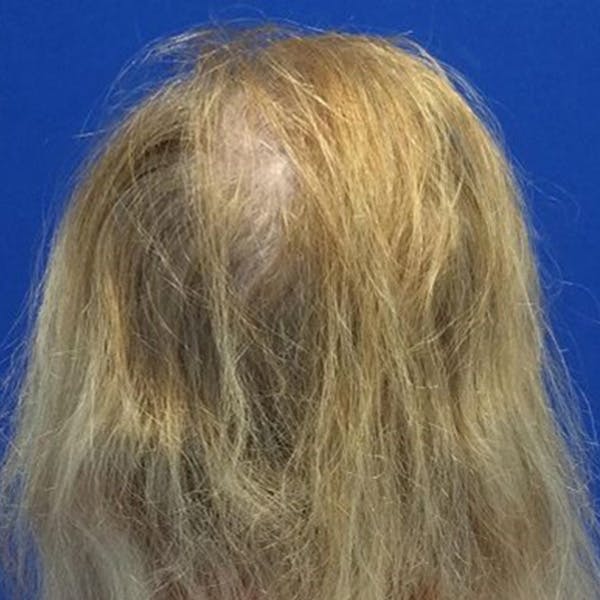 Hair Restoration Before & After Gallery - Patient 194140 - Image 2