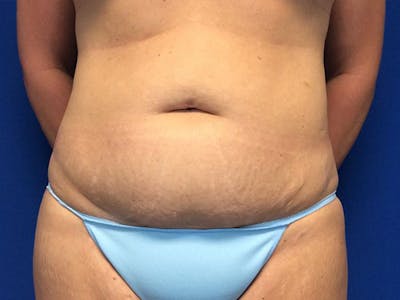 Liposuction Before & After Gallery - Patient 320702 - Image 1