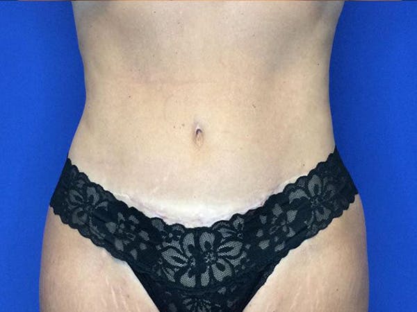 Tummy Tuck