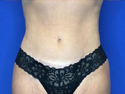 Liposuction Before & After Gallery - Patient 320702 - Image 2
