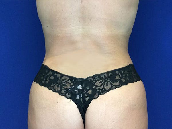 Liposuction Before & After Gallery - Patient 320702 - Image 6