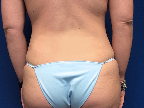 Liposuction Before & After Gallery - Patient 320702 - Image 5