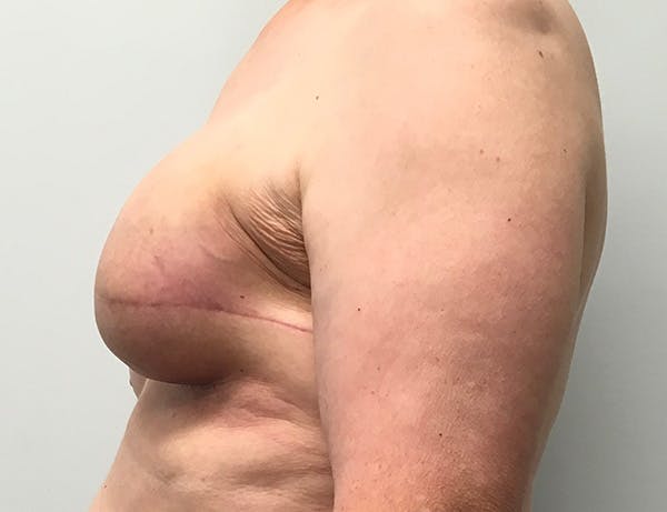 Breast DIEP Flap Reconstruction Before & After Gallery - Patient 286149 - Image 3