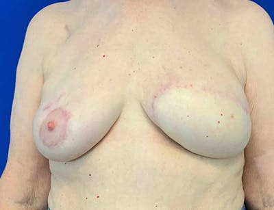 Breast DIEP Flap Reconstruction Before & After Gallery - Patient 286149 - Image 2