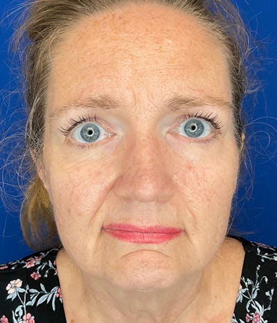 Face Lift Before & After Gallery - Patient 752310 - Image 1