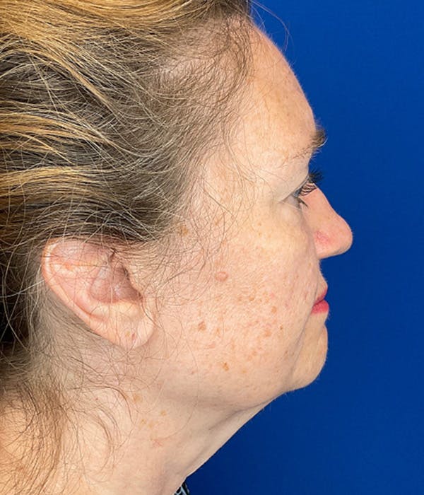 Neck Lift Before & After Gallery - Patient 312449 - Image 3