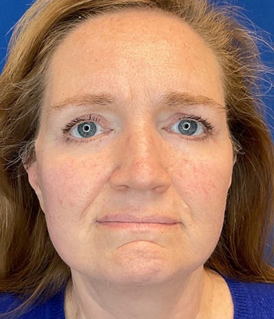 Face Lift Before & After Gallery - Patient 752310 - Image 2