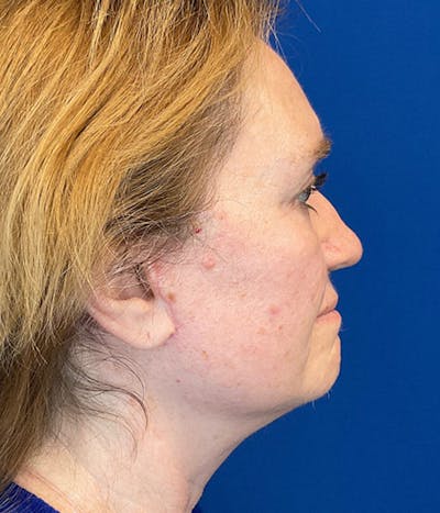 Neck Lift Before & After Gallery - Patient 312449 - Image 4