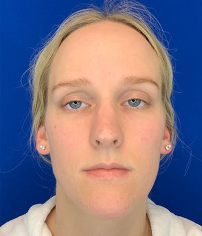 Rhinoplasty Before & After Gallery - Patient 380614 - Image 1