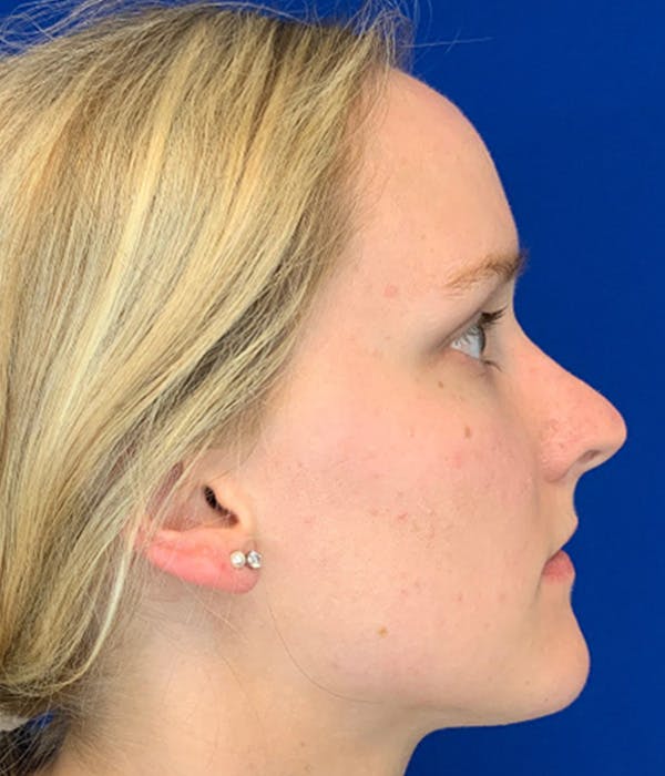 Rhinoplasty Before & After Gallery - Patient 380614 - Image 3