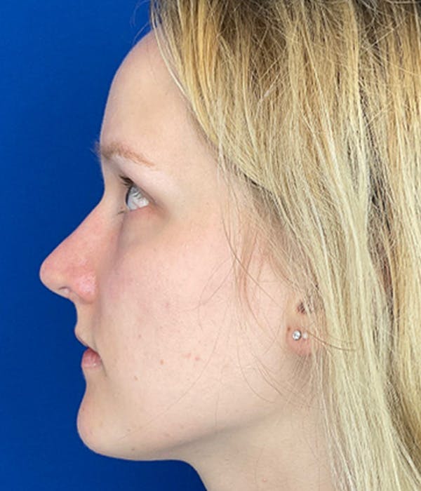 Rhinoplasty Before & After Gallery - Patient 380614 - Image 6