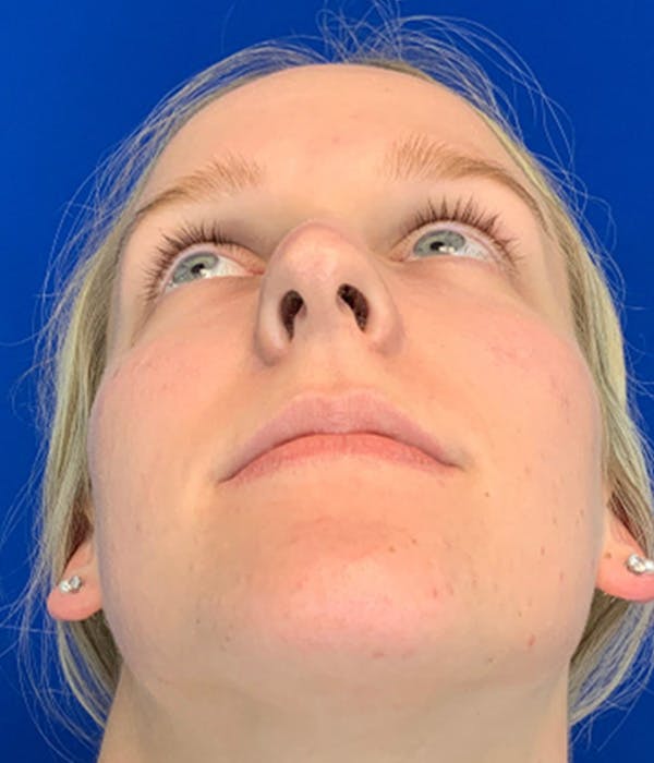 Rhinoplasty Before & After Gallery - Patient 380614 - Image 7