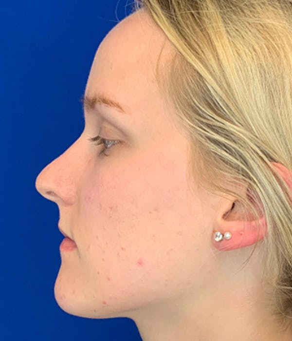 Rhinoplasty Before & After Gallery - Patient 380614 - Image 5