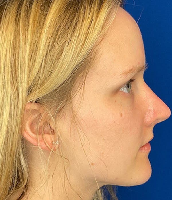 Rhinoplasty Before & After Gallery - Patient 380614 - Image 4