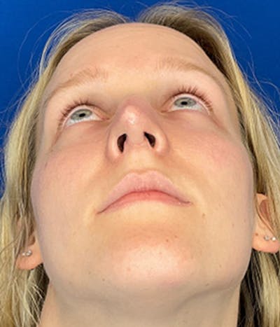 Rhinoplasty Before & After Gallery - Patient 380614 - Image 8