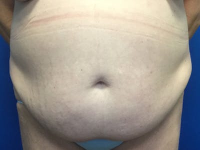 Tummy Tuck (Abdominoplasty) Before & After Gallery - Patient 115087 - Image 1