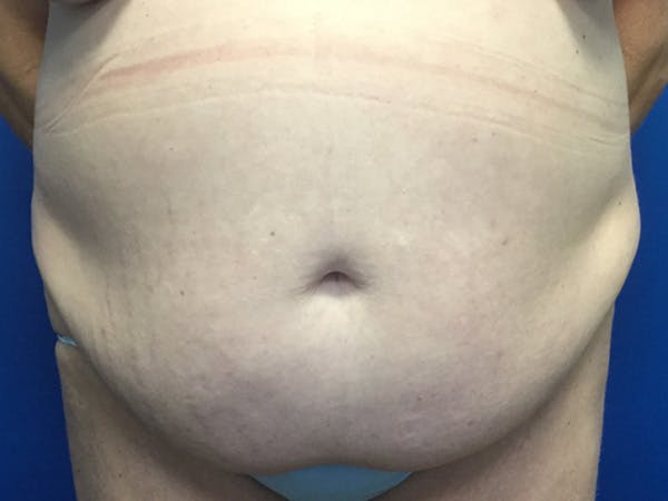 Tummy Tuck (Abdominoplasty) Before & After Gallery - Patient 115087 - Image 1