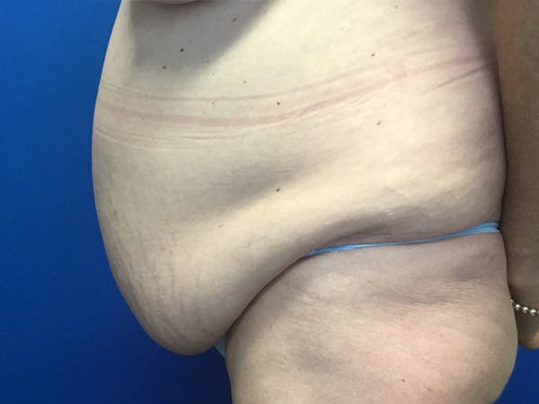 Tummy Tuck (Abdominoplasty) Before & After Gallery - Patient 115087 - Image 3