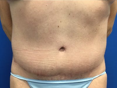 Tummy Tuck (Abdominoplasty) Before & After Gallery - Patient 115087 - Image 2