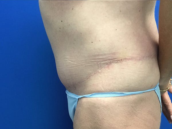 Tummy Tuck (Abdominoplasty) Before & After Gallery - Patient 115087 - Image 4