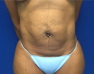 Tummy Tuck (Abdominoplasty) Before & After Gallery - Patient 168520 - Image 1