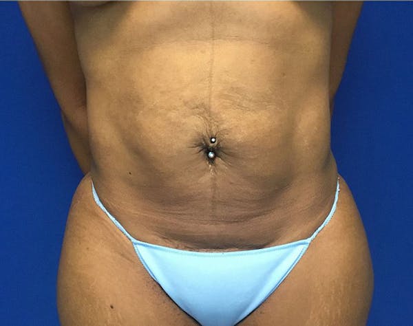 Tummy Tuck (Abdominoplasty) Before & After Gallery - Patient 168520 - Image 1