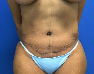 Tummy Tuck (Abdominoplasty) Before & After Gallery - Patient 168520 - Image 2