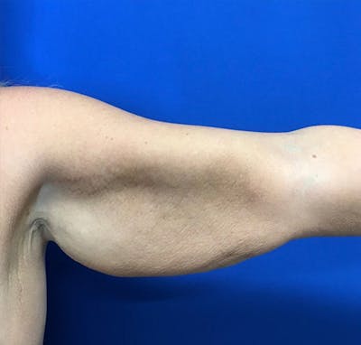Arm Lift Before & After Gallery - Patient 227712 - Image 1