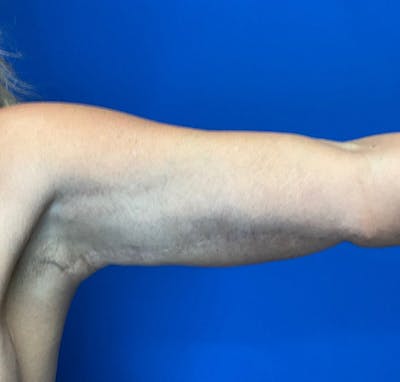 Arm Lift Before & After Gallery - Patient 227712 - Image 2