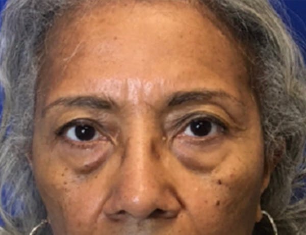 Blepharoplasty Before & After Gallery - Patient 237870 - Image 1