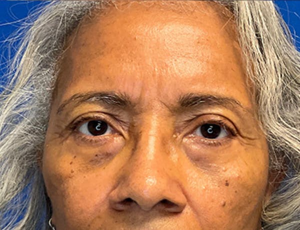 Blepharoplasty Before & After Gallery - Patient 237870 - Image 2