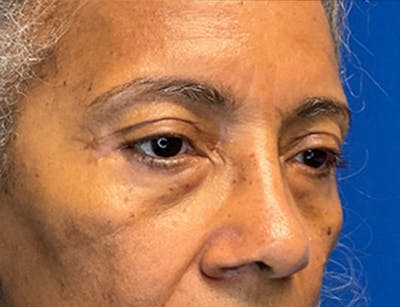 Blepharoplasty Before & After Gallery - Patient 237870 - Image 6